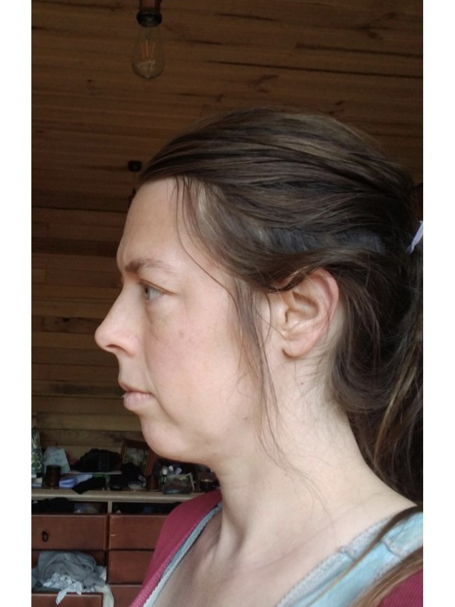 Member transformation 8 before