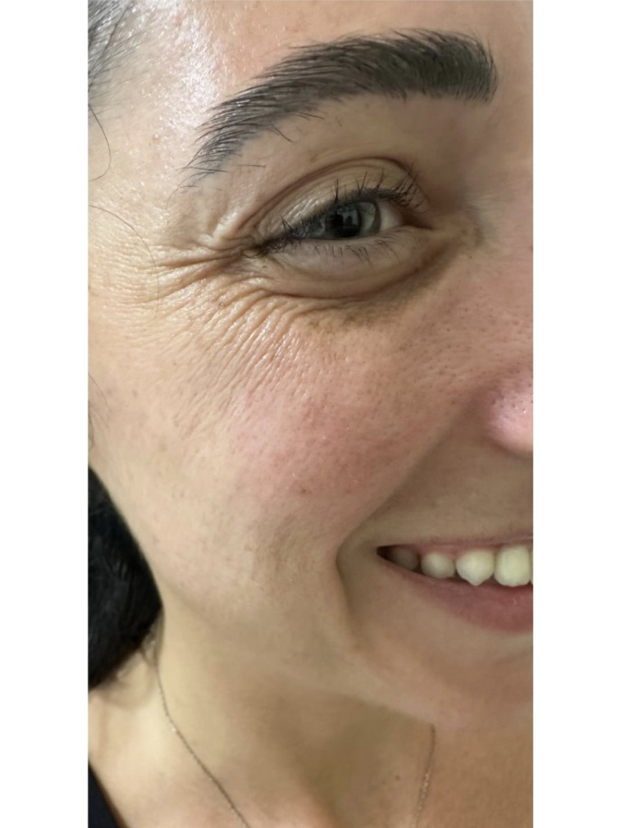 Member transformation 17 before