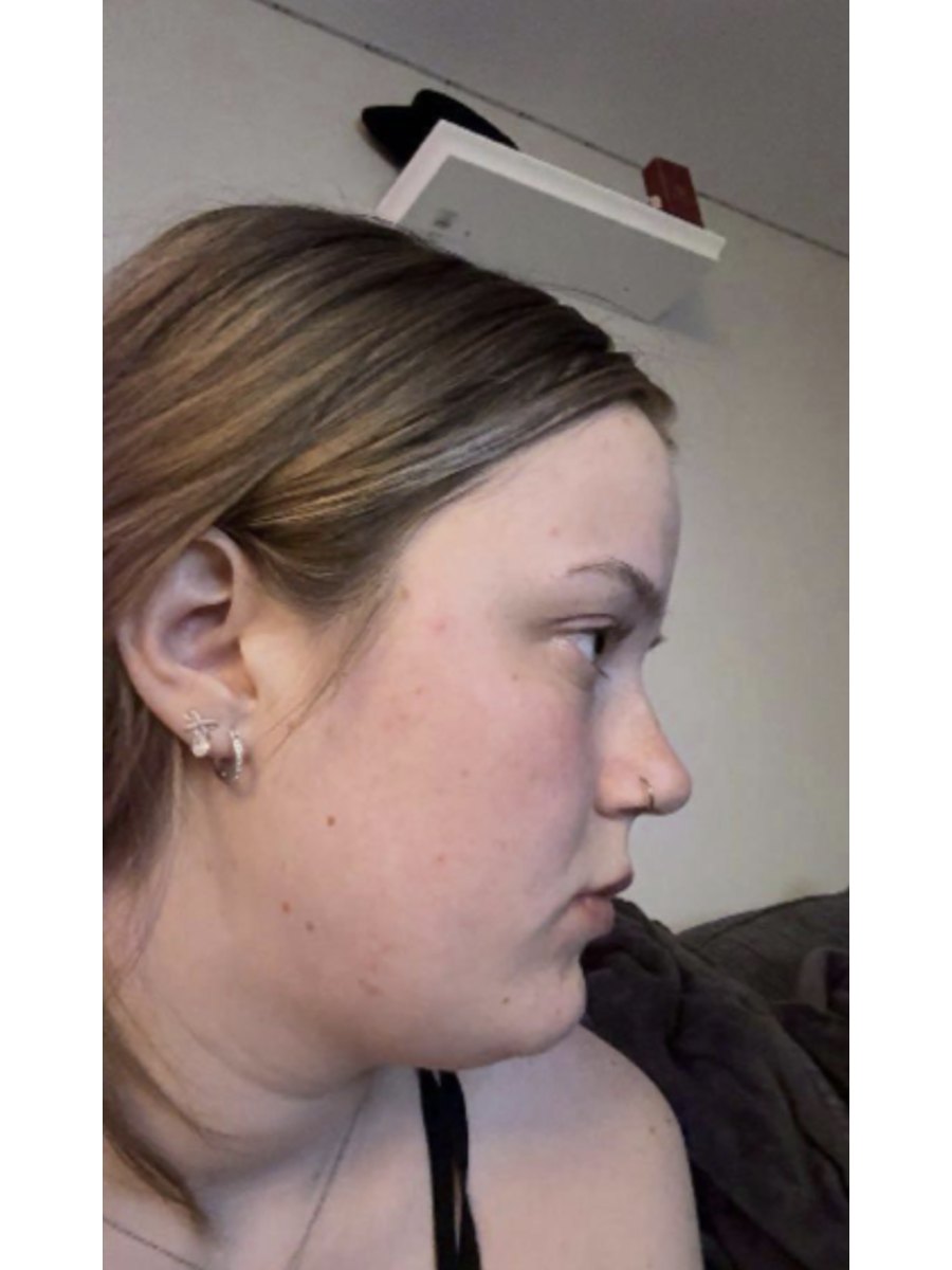 Member transformation 18 before