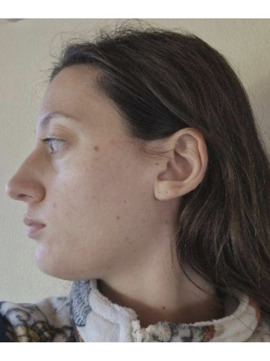 Member transformation 25 before