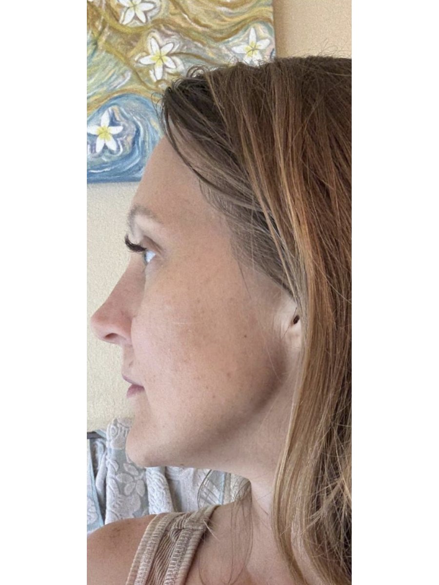 Member transformation 26 before