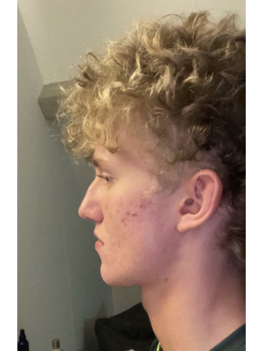 Member transformation 27 before