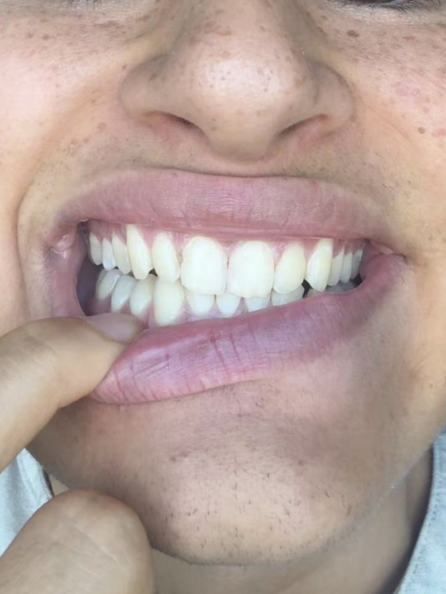 Bite after