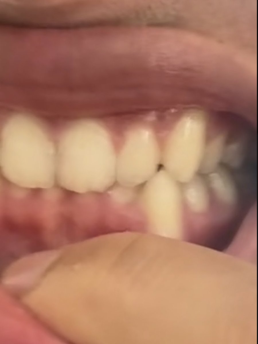 Bite before