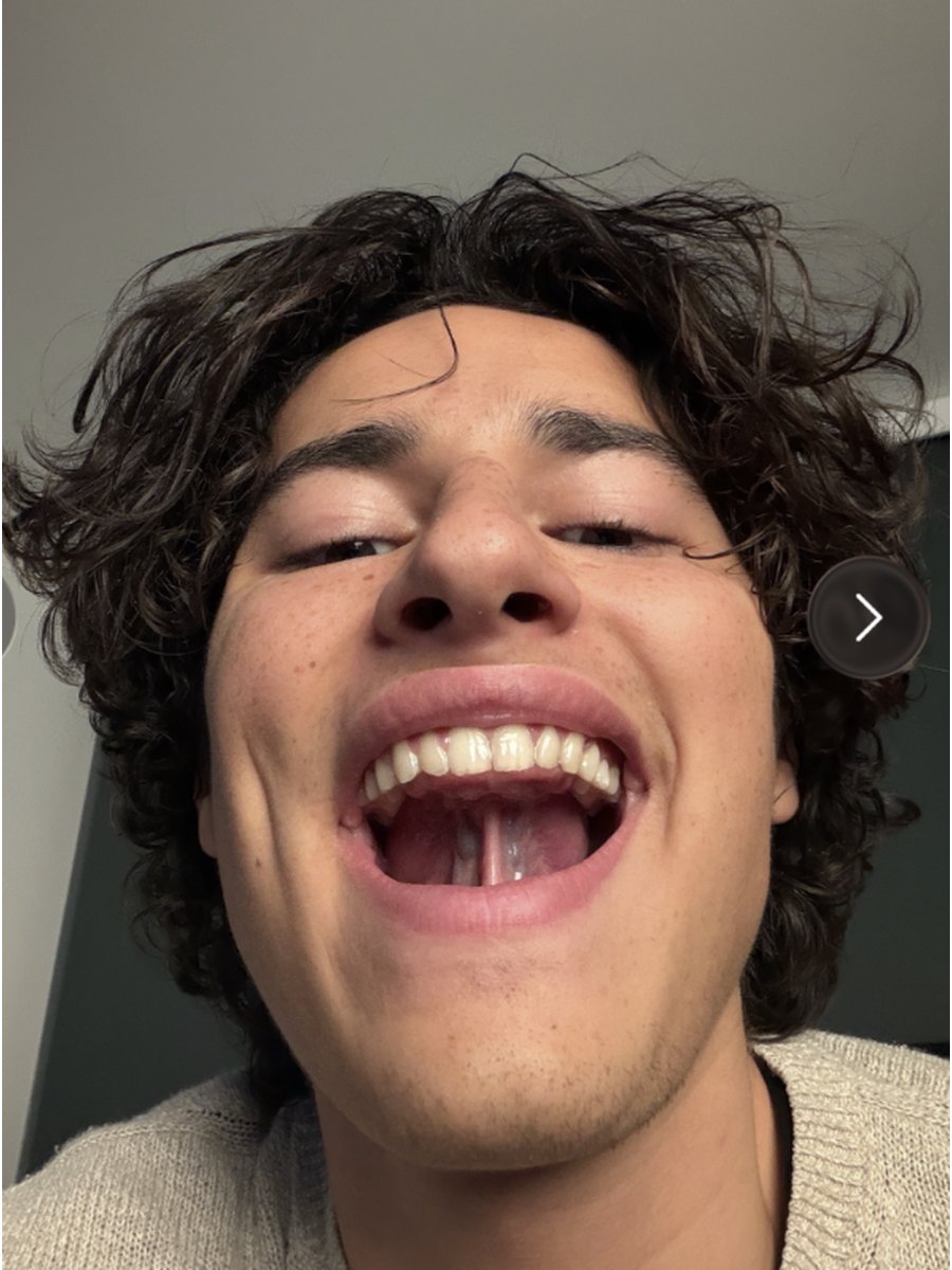 Tongue posture after